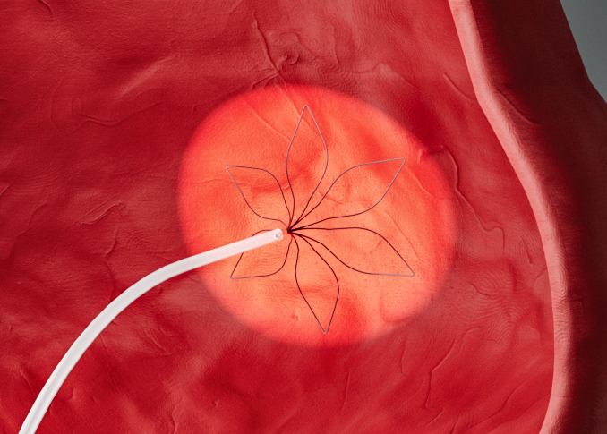 Pulsed Field Ablation
