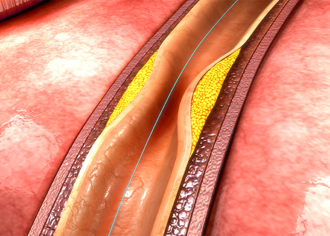 Atherectomy
