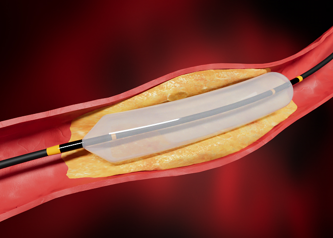 Balloon Angioplasty