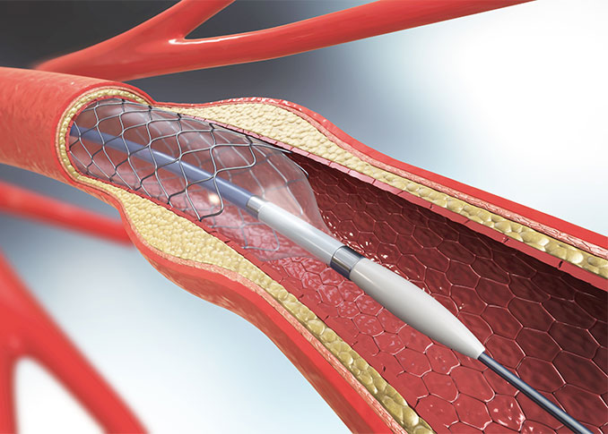 Balloon Angioplasty