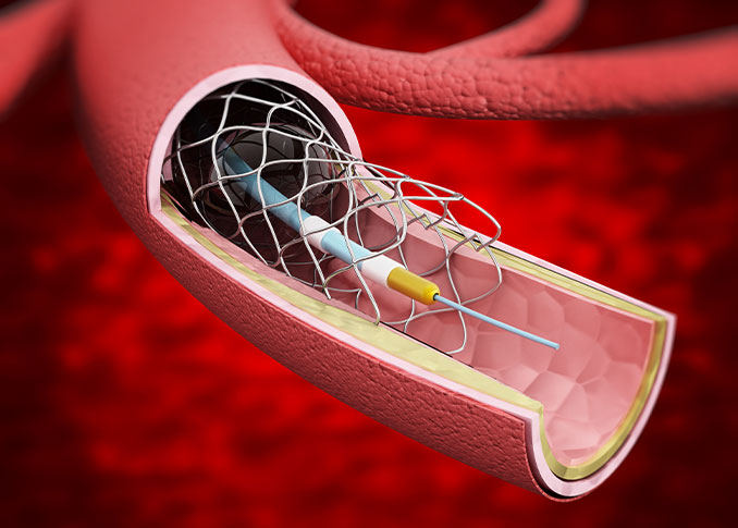 Balloon Occlusion