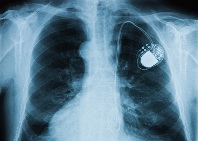 Cardiac Pacing