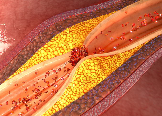 Embolic Filtration