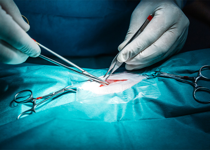 Endoscopic Vessel Harvesting