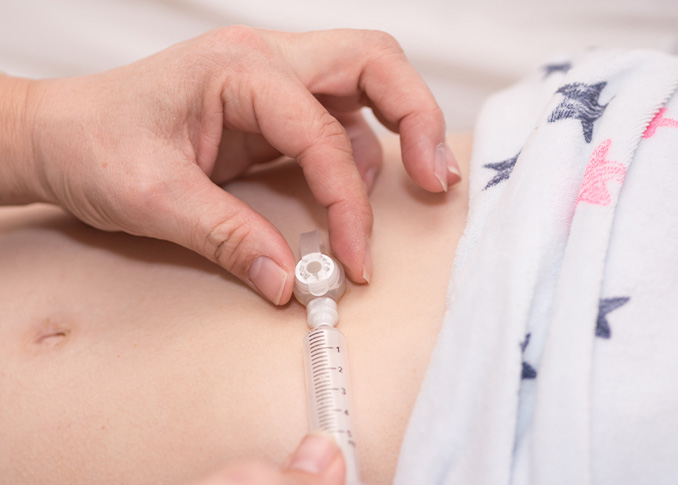 Enteral Feeding