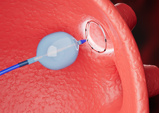 Extreme Temperature Ablation