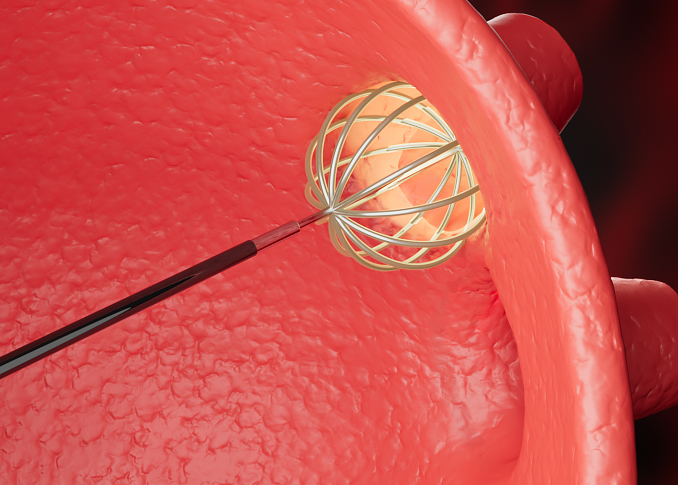 Pulsed Field Ablation