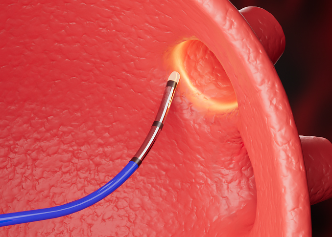 Radiofrequency Ablation