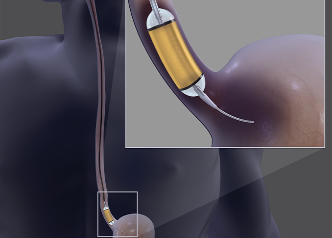 Esophageal Dilation
