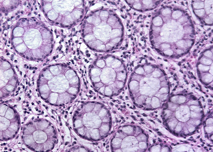 Extreme Temerature Ablation