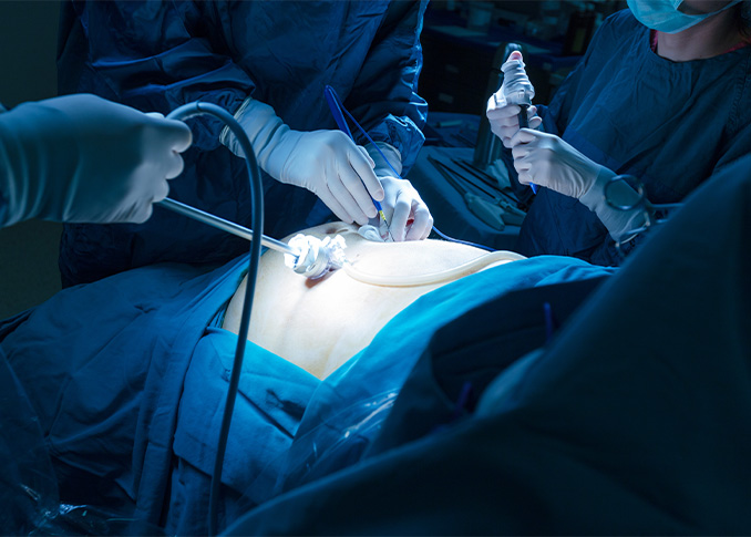 Gastric Bypass