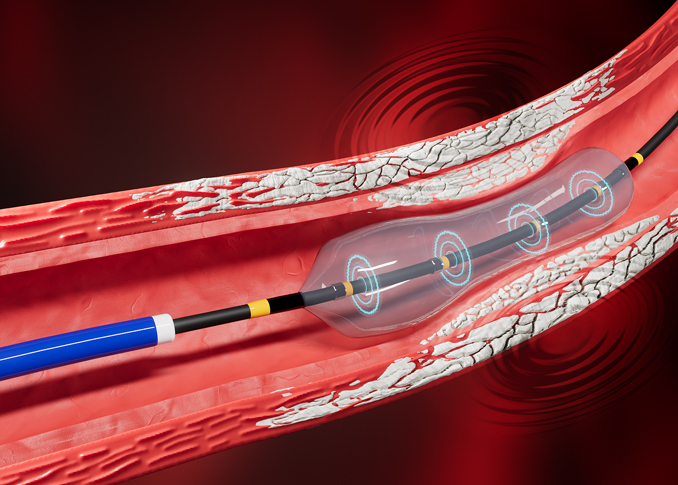 Intravascular lithotripsy (IVL)