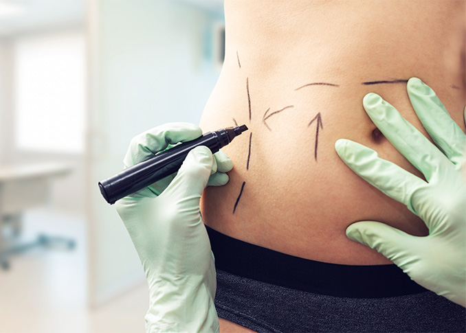 Liposuction