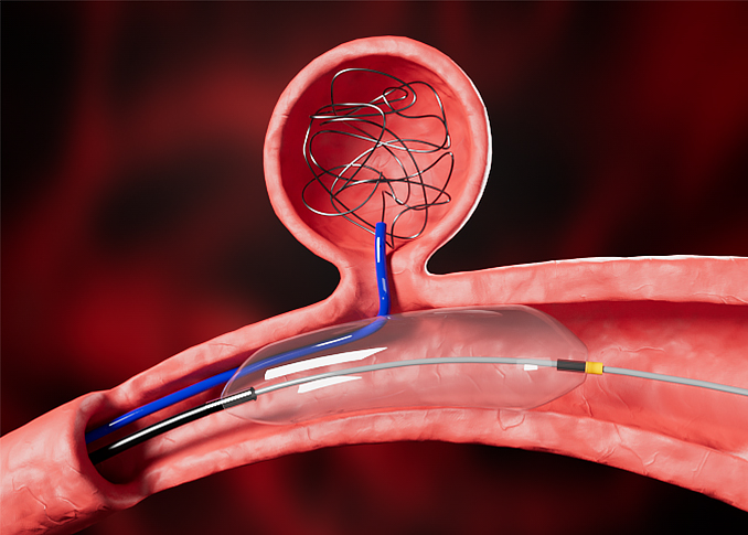 Neuro Embolization