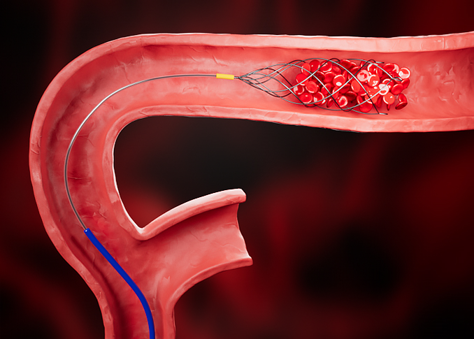 Thrombectomy