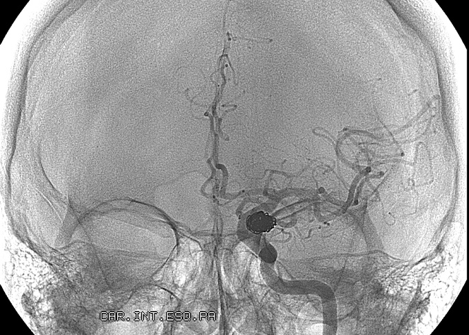 Neuroembolization