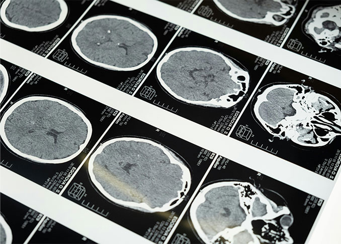 Neurosurgery