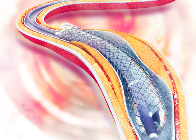 Peripheral Angioplasty