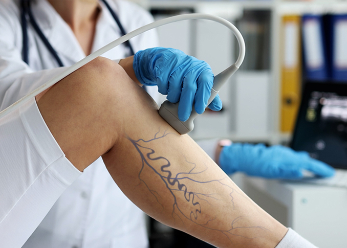 Peripheral Vascular Market