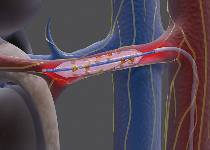 Renal Denervation