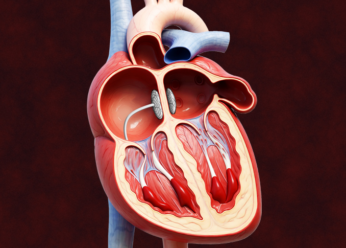 Septal Closure