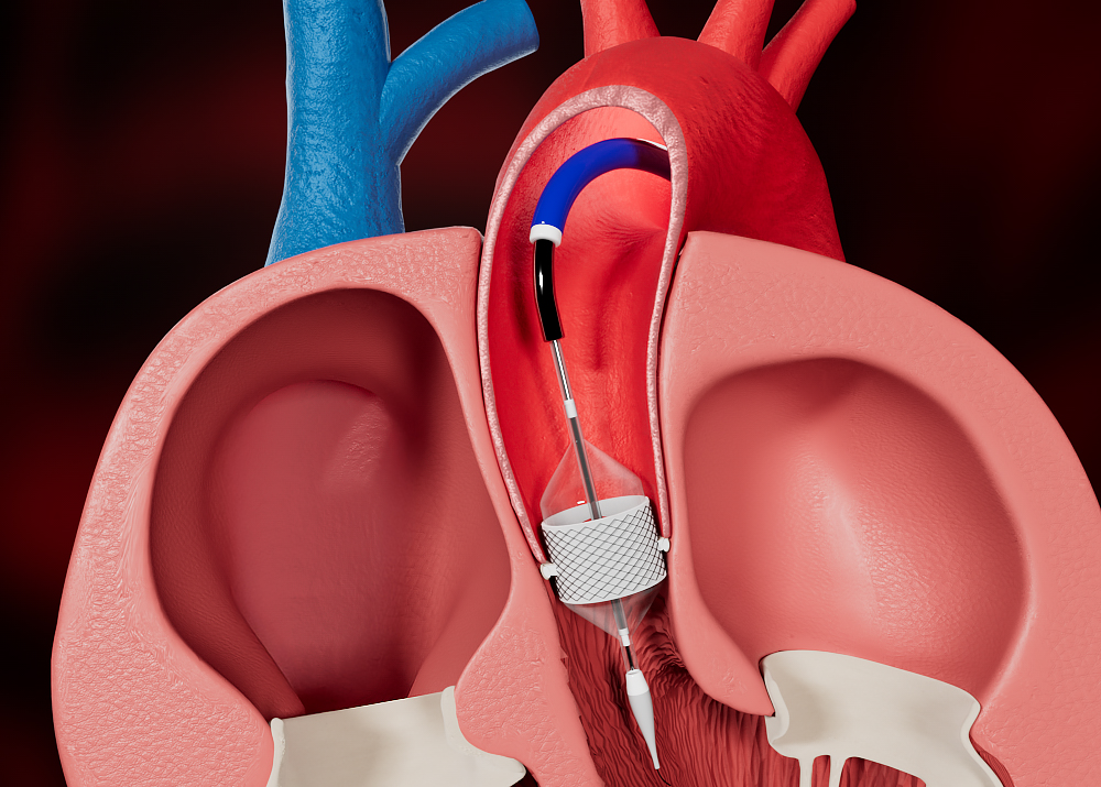 Transcatheter Aortic Valve Replacement