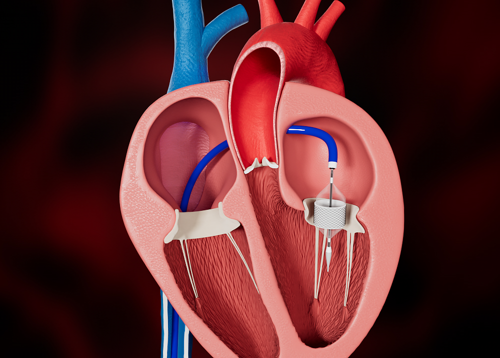 Transcatheter Mitral Valve Replacement