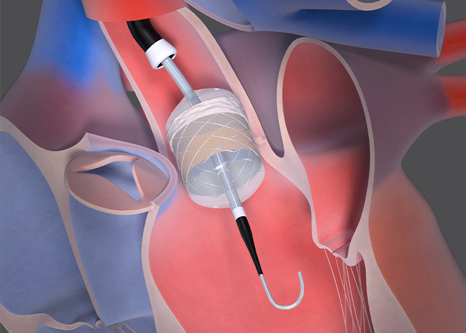 Transcatheter Mitral Valve